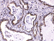 IHC testing of FFPE human intestinal cancer tissue with CASP8 antibody at 1ug/ml. HIER: steam section in pH6 citrate buffer for 20 min.