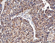 IHC staining of FFPE human hepatocellular carcinoma tissue with Angiogenin antibody. HIER: boil tissue sections in pH8 EDTA for 20 min and allow to cool before testing.