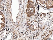 IHC staining of FFPE human lung cancer tissue with Angiogenin antibody. HIER: boil tissue sections in pH8 EDTA for 20 min and allow to cool before testing.