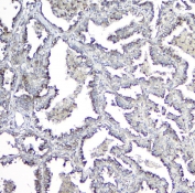 IHC staining of FFPE human lung cancer with MPI antibody at 1ug/ml. HIER: boil tissue sections in pH6, 10mM citrate buffer, for 10-20 min followed by cooling at RT for 20 min.