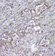 IHC staining of FFPE human intestinal cancer with MPI antibody at 1ug/ml. HIER: boil tissue sections in pH6, 10mM citrate buffer, for 10-20 min followed by cooling at RT for 20 min.