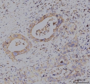 IHC staining of FFPE human breast cancer tissue with KCNQ1 antibody. HIER: boil tissue sections in pH8 EDTA for 20 min and allow to cool before testing.