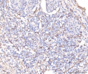 IHC staining of FFPE human lung cancer tissue with KCNQ1 antibody. HIER: boil tissue sections in pH8 EDTA for 20 min and allow to cool before testing.