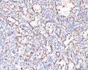 IHC staining of FFPE human liver cancer tissue with KCNQ1 antibody. HIER: boil tissue sections in pH8 EDTA for 20 min and allow to cool before testing.