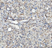IHC staining of FFPE human liver cancer tissue with HLA-DPB1 antibody. HIER: boil tissue sections in pH8 EDTA for 20 min and allow to cool before testing.