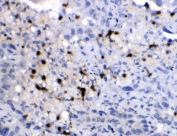 IHC testing of FFPE human lung cancer tissue with NEDD8 antibody at 1ug/ml. HIER: steam section in pH6 citrate buffer for 20 min.