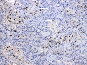 IHC testing of FFPE human lung cancer tissue with NEDD8 antibody at 1ug/ml. HIER: steam section in pH6 citrate buffer for 20 min.