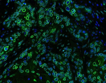 Immunofluorescent staining of FFPE human esophageal squamous cell carcinoma with Emerin antibody (green) at 1ug/ml and DAPI nuclear stain (blue). HIER: boil tissue sections in pH6, 10mM citrate buffer, for 10-20 min and allow to cool before testing.