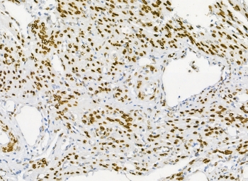 IHC staining of FFPE human endometrial carcinoma with Emerin antibody at 1ug/ml. HIER: boil tissue sections in pH6, 10mM citrate buffer, for 10-20 min and allow to cool before testing.