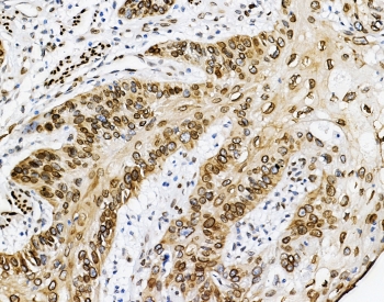 IHC staining of FFPE human esophageal squamous cell carcinoma with Emerin antibody at 1ug/ml. HIER: boil tissue sections in pH6, 10mM citrate buffer, for 10-20 min and allow to cool before testing.