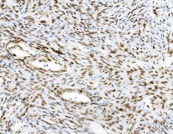 IHC staining of FFPE human colon cancer with Emerin antibody at 1ug/ml. HIER: boil tissue sections in pH6, 10mM citrate buffer, for 10-20 min and allow to cool before testing.
