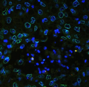 Immunofluorescent staining of FFPE human lung cancer tissue with Emerin antibody (green) at 2ug/ml and DAPI nuclear stain (blue). HIER: boil tissue sections in pH8 EDTA for 10-20 min and allow to cool before testing.