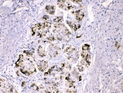 IHC testing of FFPE human liver cancer tissue with Fibrinogen gamma chain antibody at 1ug/ml. HIER: steam section in pH6 citrate buffer for 20 min.