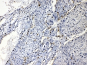 IHC testing of FFPE human liver cancer tissue with Purine nucleoside phosphorylase antibody at 1ug/ml. HIER: steam section in pH6 citrate buffer for 20 min.