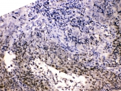 IHC testing of FFPE human lung carcinoma with HDGF antibody at 1ug/ml. HIER: steam section in pH6 citrate buffer for 20 min.