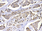 IHC staining of FFPE human lung cancer with MUT antibody. HIER: boil tissue sections in pH6, 10mM citrate buffer, for 20 min and allow to cool before testing.