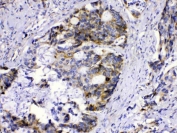 IHC staining of FFPE human intestinal cancer with MUT antibody. HIER: boil tissue sections in pH6, 10mM citrate buffer, for 20 min and allow to cool before testing.