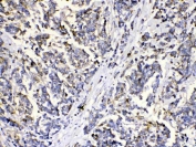 IHC staining of FFPE human breast cancer with MUT antibody. HIER: boil tissue sections in pH6, 10mM citrate buffer, for 20 min and allow to cool before testing.