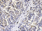 IHC staining of FFPE human breast cancer with MUT antibody. HIER: boil tissue sections in pH6, 10mM citrate buffer, for 20 min and allow to cool before testing.