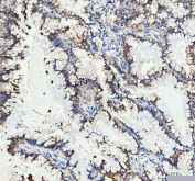 Immunohistochemical staining of FFPE human lung cancer tissue with MUT antibody, HRP-secondary and DAB substrate. HIER: boil tissue sections in pH8 EDTA for 20 min and allow to cool before testing.