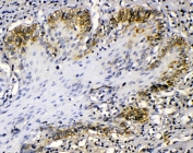 IHC testing of FFPE human esophageal squamous cancer with Cytokeratin 14 antibody at 1ug/ml. HIER: steam section in pH6 citrate buffer for 20 min.