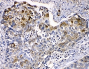 IHC testing of FFPE human esophageal squamous cancer with Cytokeratin 14 antibody at 1ug/ml. HIER: steam section in pH6 citrate buffer for 20 min.