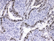 IHC testing of human intestinal cancer with hnRNP A1 antibody at 1ug/ml. HIER: steam section in pH6 citrate buffer for 20 min.