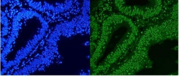 Immunofluorescent staining of FFPE human rectal cancer with hnRNP A1 antibody (green) and DAPI nuclear stain (blue). HIER: steam section in pH8 EDTA for 20 min.