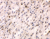 IHC testing of FFPE human glioma with Beta III Tubulin antibody at 1ug/ml. HIER: steam section in pH6 citrate buffer for 20 min.