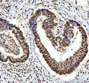 IHC staining of FFPE human colorectal adenocarcinoma tissue with hnRNP L antibody. HIER: boil tissue sections in pH8 EDTA for 20 min and allow to cool before testing.