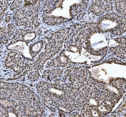 IHC staining of FFPE human breast cancer tissue with hnRNP L antibody. HIER: boil tissue sections in pH8 EDTA for 20 min and allow to cool before testing.
