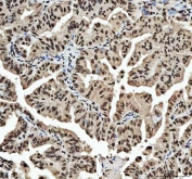 IHC staining of FFPE human lung adenocarcinoma tissue with hnRNP L antibody. HIER: boil tissue sections in pH8 EDTA for 20 min and allow to cool before testing.