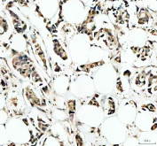 IHC staining of FFPE human breast cancer tissue with IRF9 antibody, HRP-secondary and DAB substrate. HIER: boil tissue sections in pH8 EDTA for 20 min and allow to cool before testing.