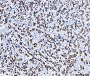 IHC staining of FFPE human breast cancer tissue with hnRNP H antibody. HIER: boil tissue sections in pH8 EDTA for 20 min and allow to cool before testing.