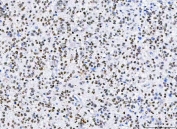 IHC staining of FFPE human glioblastoma tissue with hnRNP H antibody. HIER: boil tissue sections in pH8 EDTA for 20 min and allow to cool before testing.