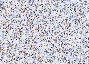 IHC staining of FFPE human glioblastoma tissue with hnRNP H antibody. HIER: boil tissue sections in pH8 EDTA for 20 min and allow to cool before testing.