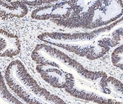 IHC staining of FFPE human colorectal adenocarcinoma tissue with hnRNP H antibody. HIER: boil tissue sections in pH8 EDTA for 20 min and allow to cool before testing.