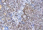 IHC staining of FFPE human ovarian serous adenocarcinoma tissue with hnRNP H antibody. HIER: boil tissue sections in pH8 EDTA for 20 min and allow to cool before testing.