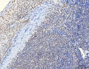 IHC staining of FFPE human tonsil tissue with hnRNP H antibody. HIER: boil tissue sections in pH8 EDTA for 20 min and allow to cool before testing.