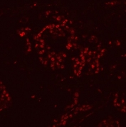 Immunofluorescent staining of FFPE human breast cancer tissue with hnRNP H antibody (red). HIER: steam section in pH8 EDTA buffer for 20 min.