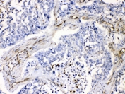 IHC testing of FFPE human lung cancer tissue with VASP antibody at 1ug/ml. HIER: steam section in pH6 citrate buffer for 20 min.