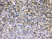 IHC testing of FFPE human Hepatitis B+ tissue with Hepatitis B Virus antibody at 0.5ug/ml. HIER: steam section in pH6 citrate buffer for 20 min and allow to cool prior to testing.