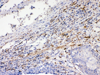 IHC testing of FFPE human lung cancer tissue with DVL1 antibody at 1ug/ml. Required HIER: steam section in pH6 citrate b