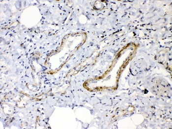 IHC testing of FFPE human lung cancer tissue with Angiopoietin 2 antibody at 1ug/ml. Required HIER: steam section in pH6 citrate buffer for 20 min and allow to cool prior to testing.