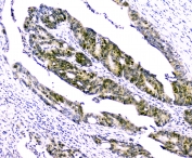 IHC staining of FFPE human intestinal cancer with Survivin antibody. HIER: boil tissue sections in pH6, 10mM citrate buffer, for 10-20 min and allow to cool before testing.
