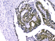 IHC staining of FFPE human intestinal cancer with Survivin antibody. HIER: boil tissue sections in pH6, 10mM citrate buffer, for 10-20 min and allow to cool before testing.