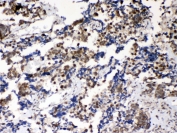 IHC testing of FFPE human lung cancer tissue with Musashi antibody at 1ug/ml. Required HIER: steam section in pH6 citrate buffer for 20 min and allow to cool prior to testing.