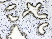 IHC testing of FFPE human breast cancer tissue with Musashi antibody at 1ug/ml. Required HIER: steam section in pH6 citrate buffer for 20 min and allow to cool prior to testing.