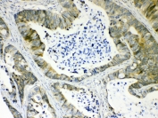 IHC testing of FFPE human liver cancer tissue with AKR1B10 antibody at 1ug/ml. Required HIER: steam section in pH6 citrate buffer for 20 min and allow to cool prior to testing.