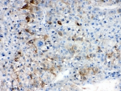 IHC testing of FFPE human liver cancer tissue with AKR1B10 antibody. Required HIER: steam section in pH6 citrate buffer for 20 min and allow to cool prior to testing.